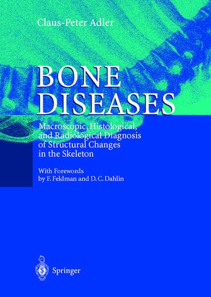 Bone Diseases