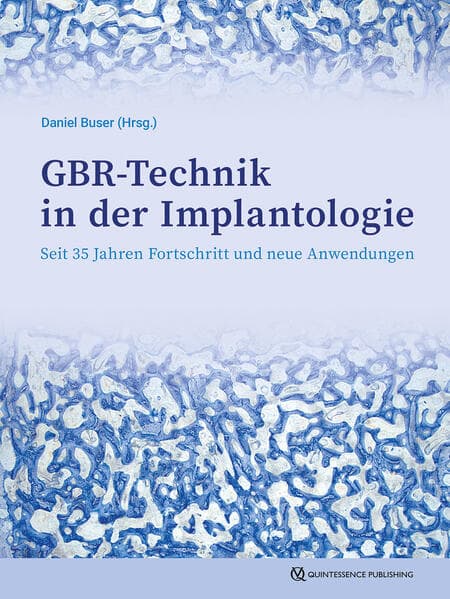 GBR-Technik in der Implantologie