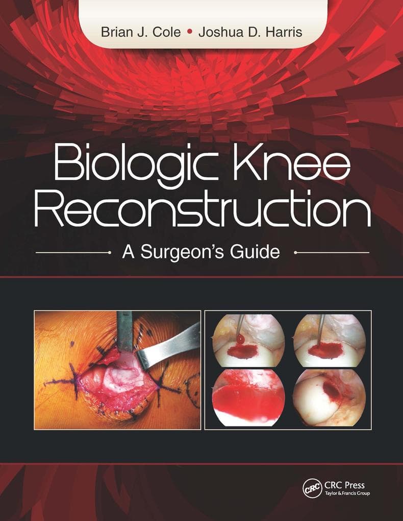 Biologic Knee Reconstruction: A Surgeon's Guide
